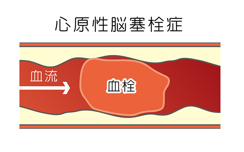 心原性脳塞栓症:イメージ画像